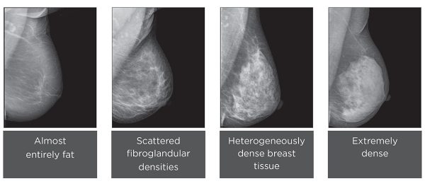 what-is-breast-density-and-why-is-it-important-consulting