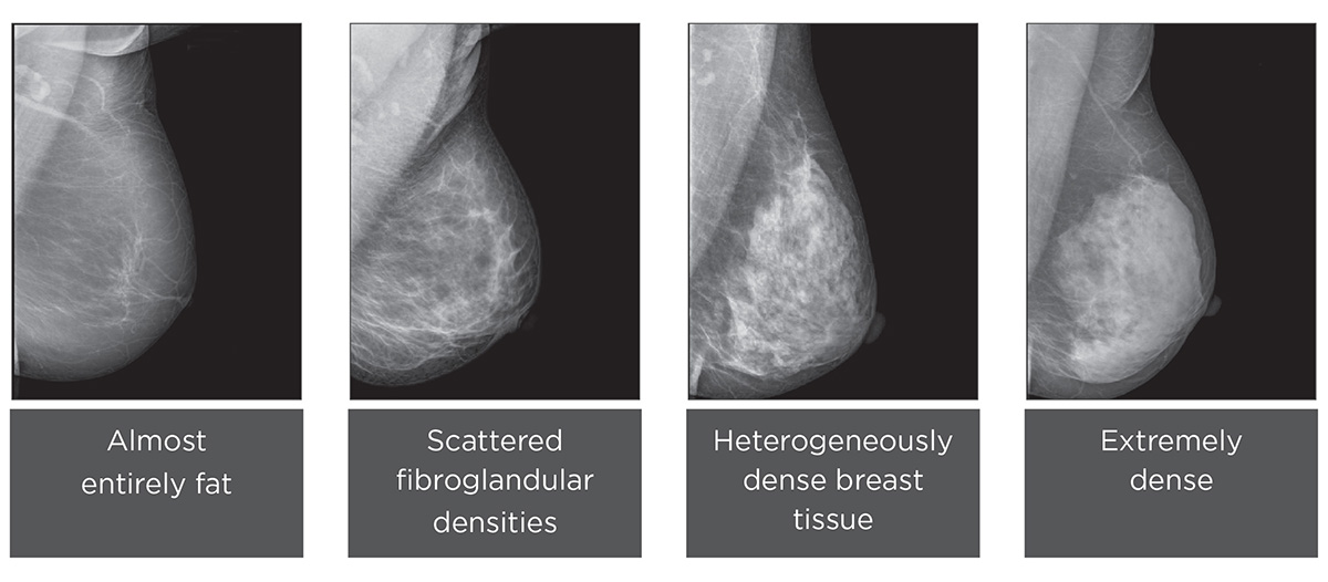 Breast Density  Consulting Radiologists