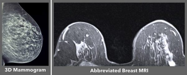 Abbreviated Breast MRI | Consulting Radiologists